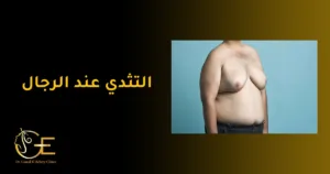 علاج التثدي عند الرجال علاج التثدي عند الرجال