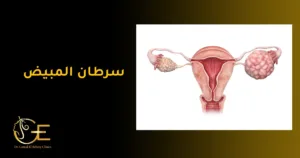 سرطان المبيض